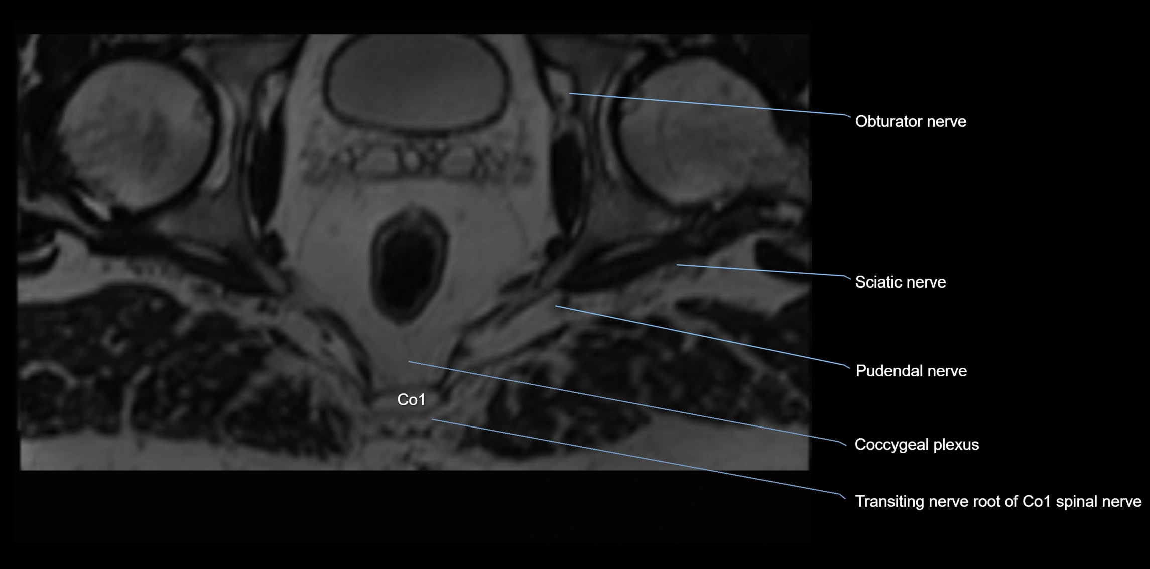 MR lumbosacral plexus axial cross sectional anatomy 3T  radiology  image-img-1008001-00124.webp